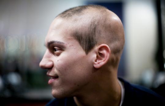 Alopecia areata 2