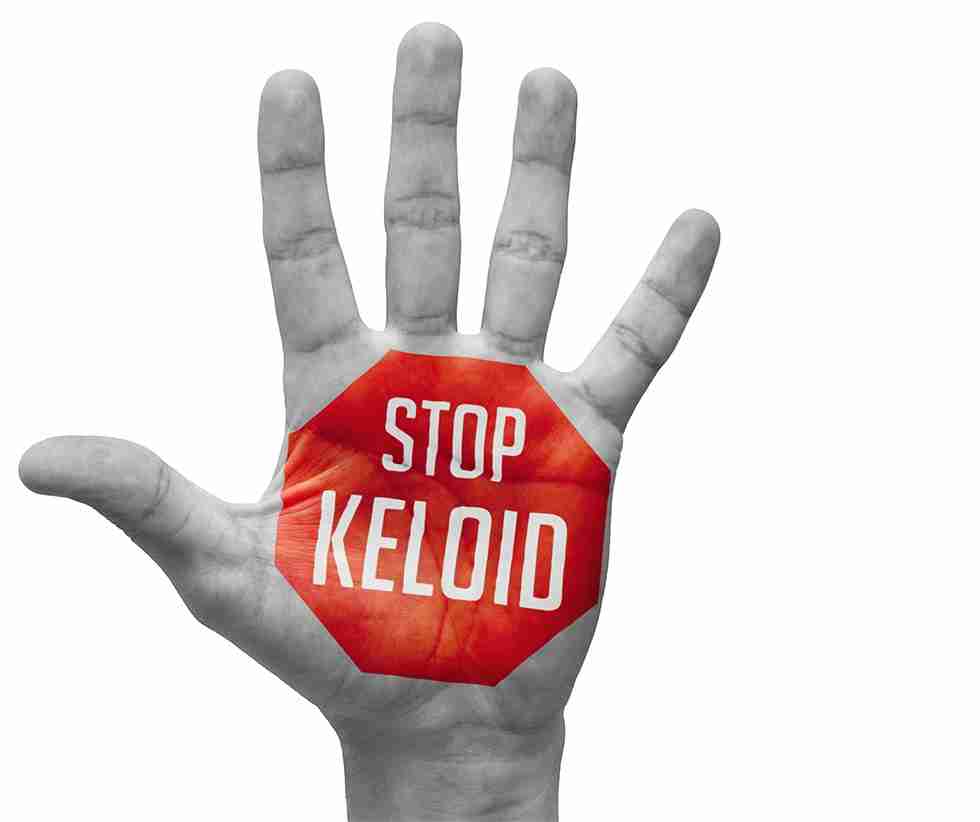 keloid