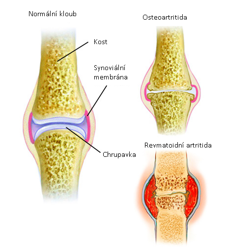 reumatitídna artritída
