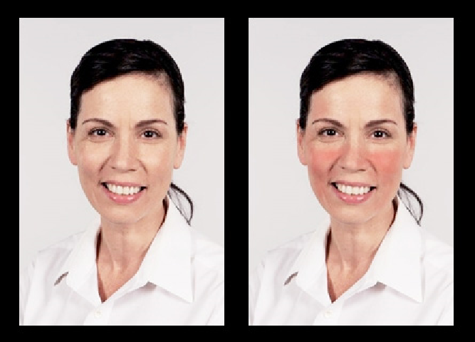 Vľavo žena s čistou pleťou, vpravo digitálne upravená fotografia tak, aby simulovala symptómy rosacey rosacea