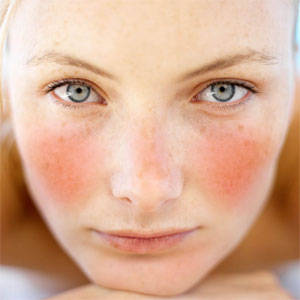 Rosacea 2